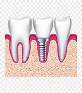 Servicios de Rehabilitación Oral Protésica por Flujo Digital